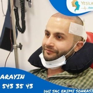 Hair transplant in Istanbul Turkey